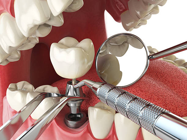 Best Emergency Root Canal Treatment in Wamac, IN